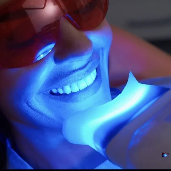 Blanqueamiento Dental, tratamiento dental en Clínica Beauty Line, La Serena