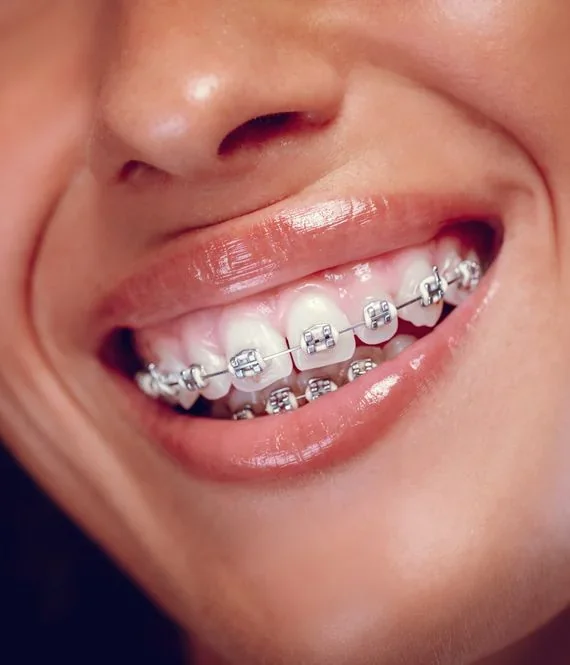 Brackets Metalicos, tratamiento dental en Clínica Beauty Line, La Serena